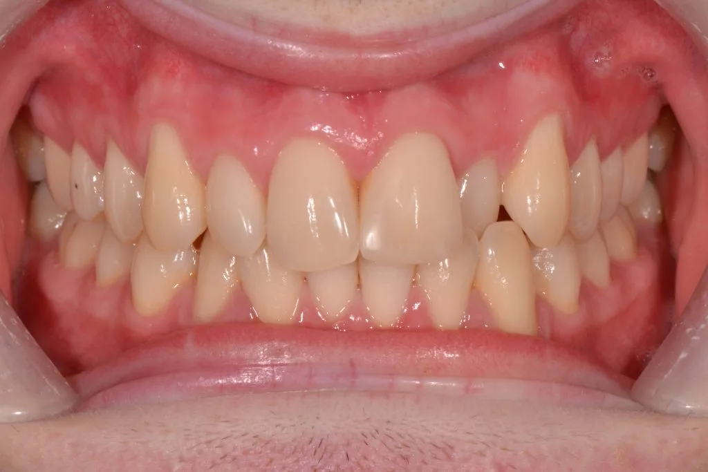 clear braces harrogate