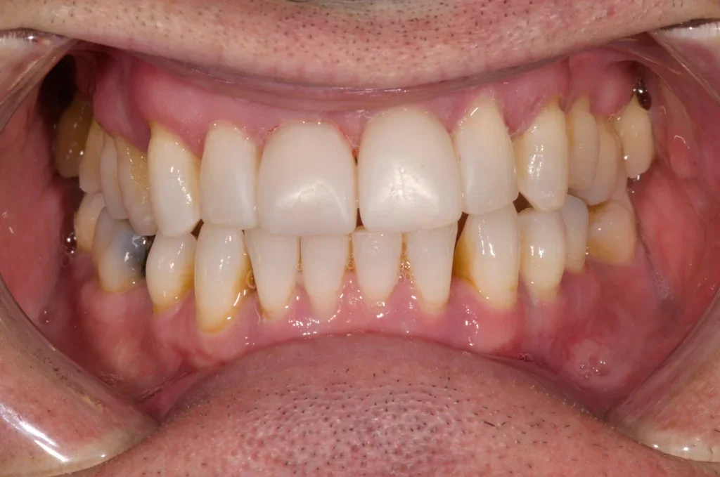 cosmetic bonding harrogate