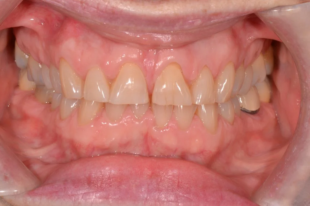 composite bonding before harrogate