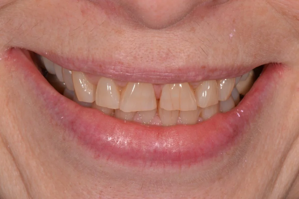 composite bonding harrogate