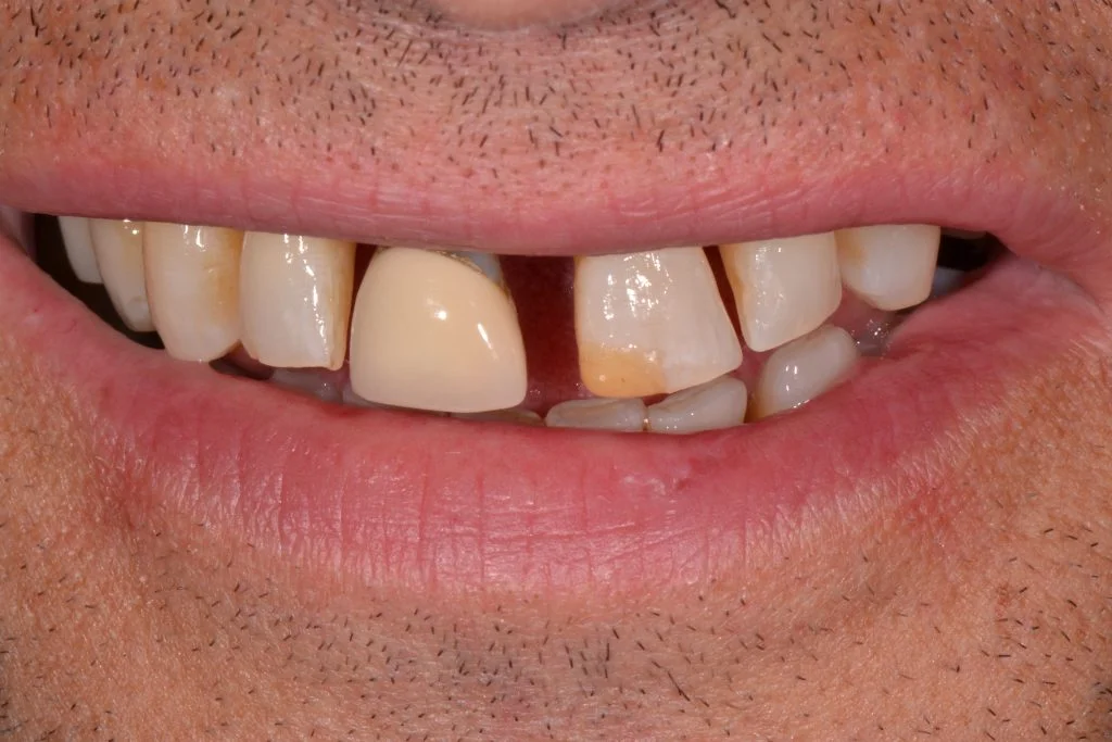 composite bonding near harrogate