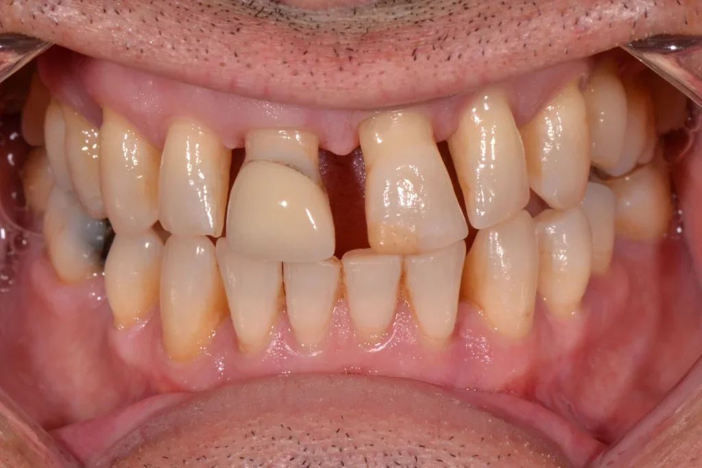 dental bonding harrogate