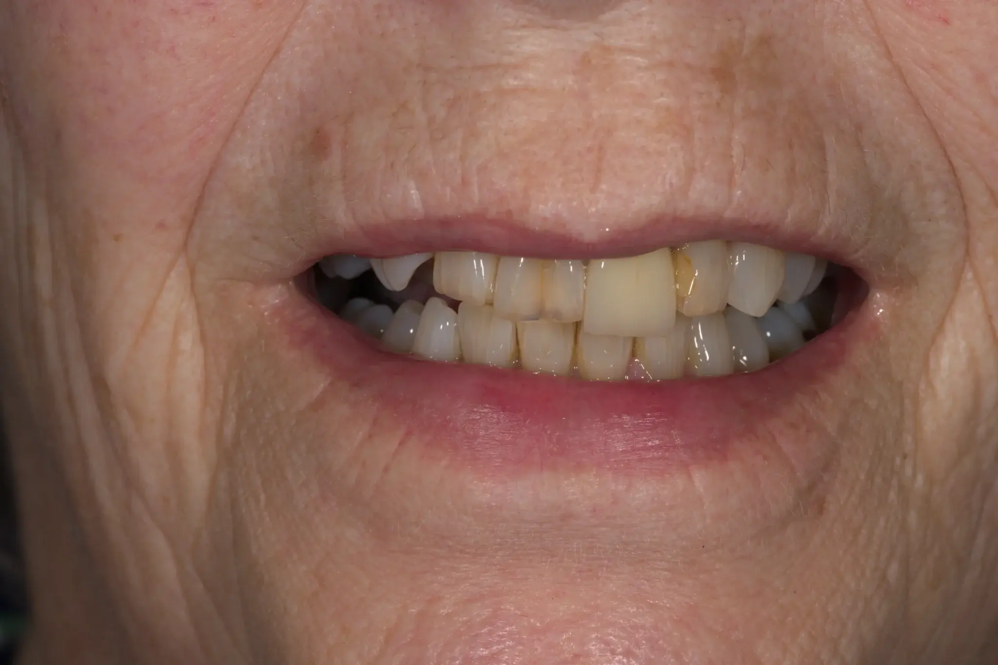 tooth implants harrogate