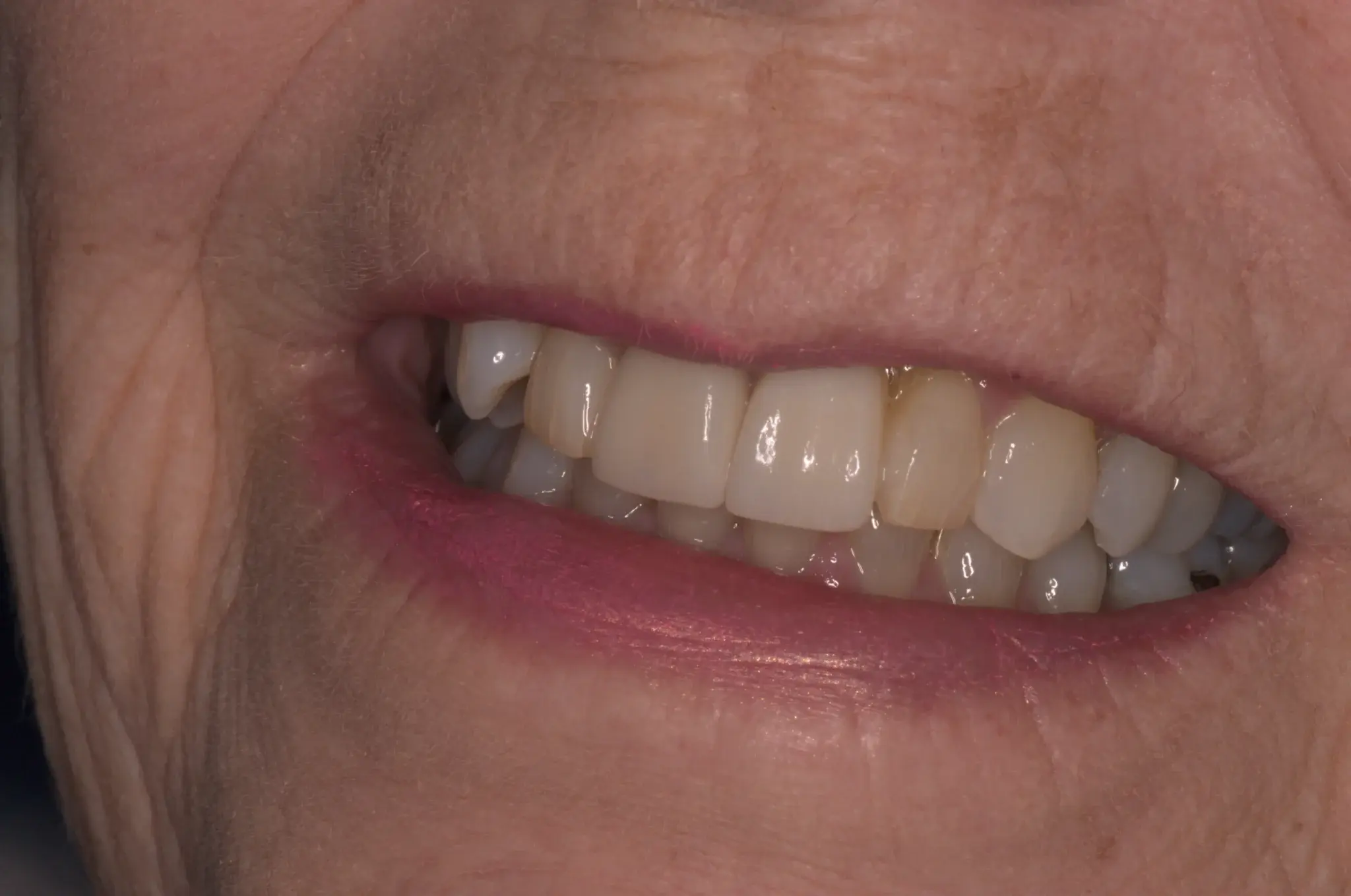 teeth implants harrogate