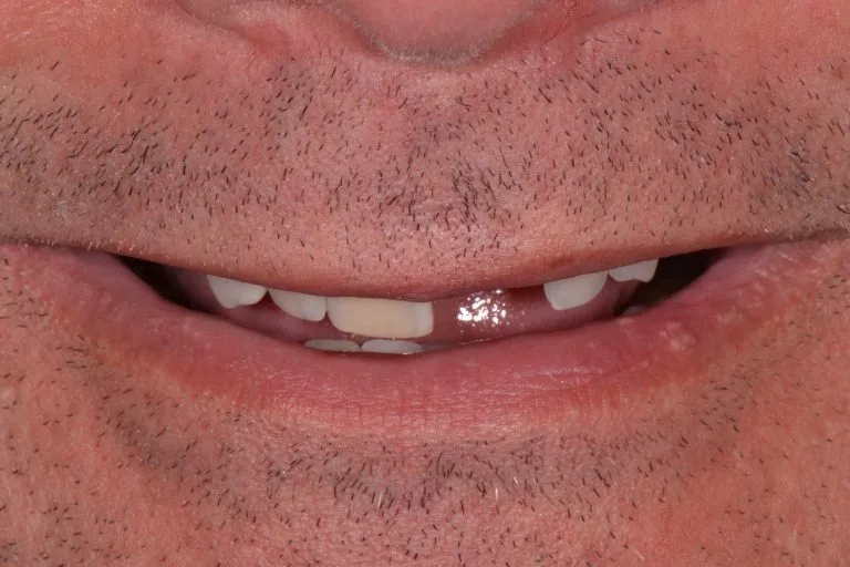 dental implants harrogate