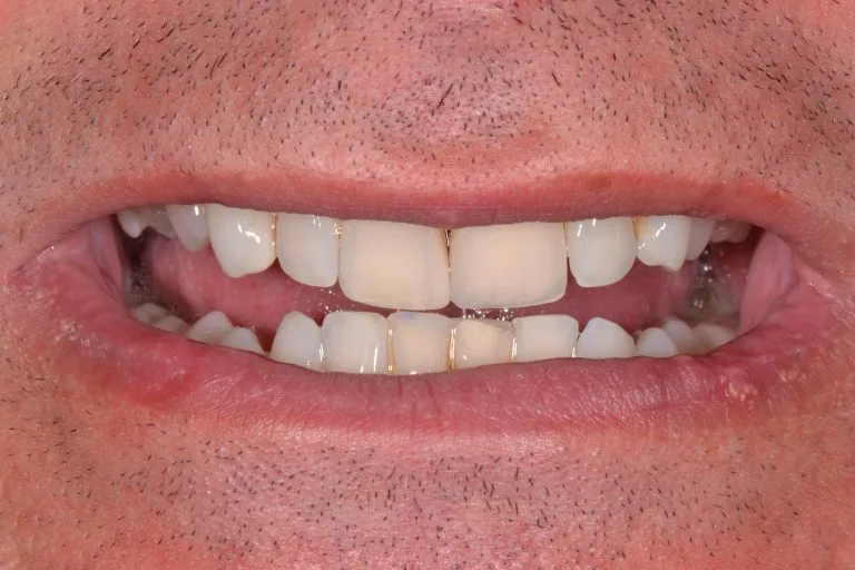 dental implants in harrogate