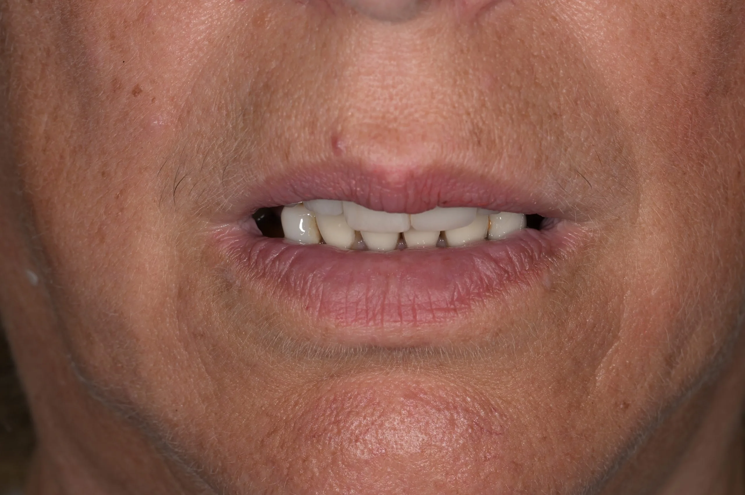 dental implants near harrogate