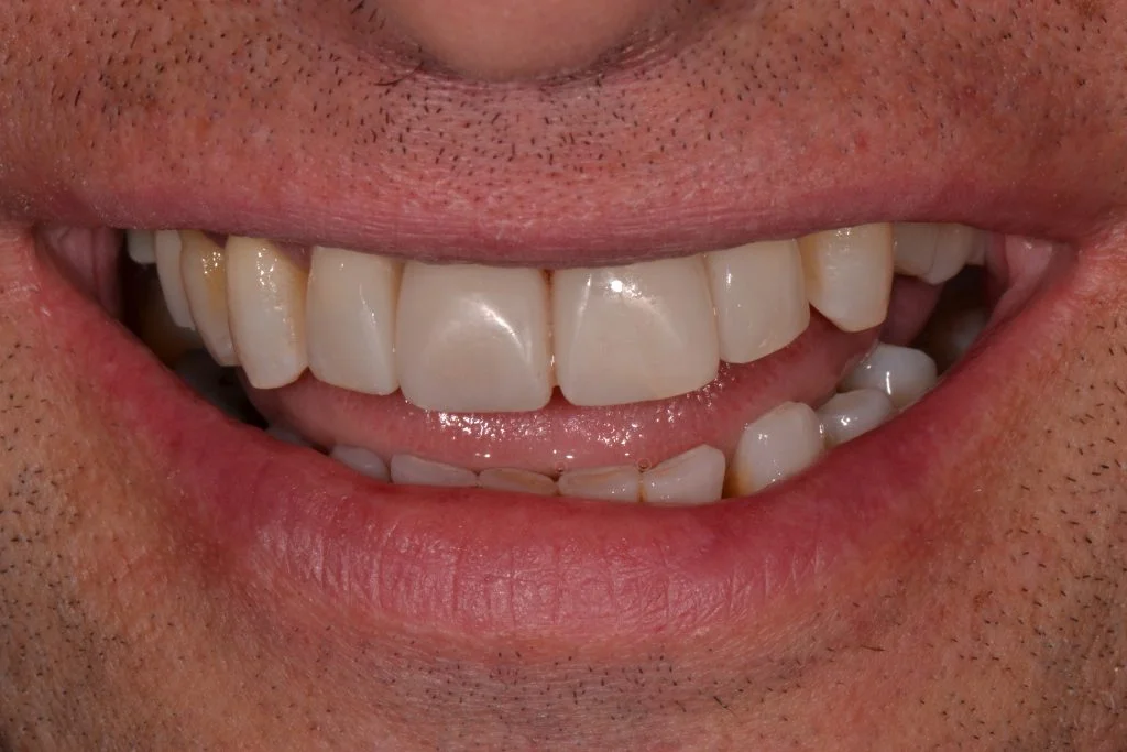 teeth bonding harrogate