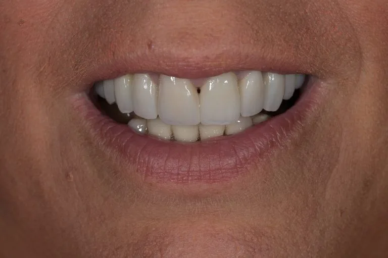 harrogate dental implants