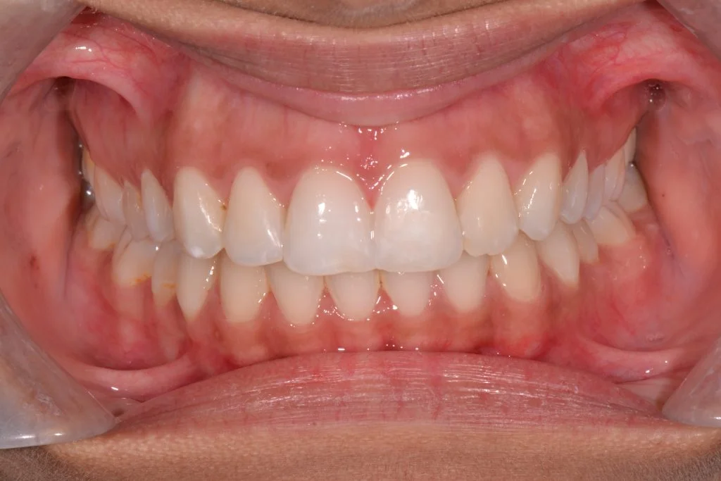 harrogate invisalign braces