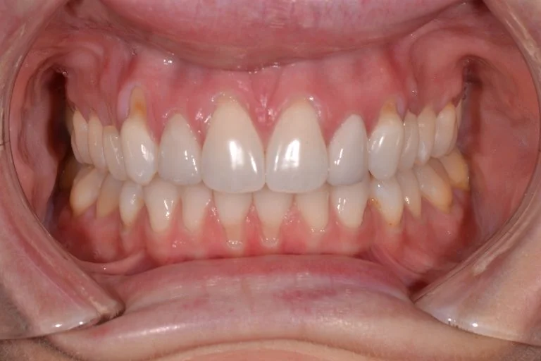 invisalign in harrogate