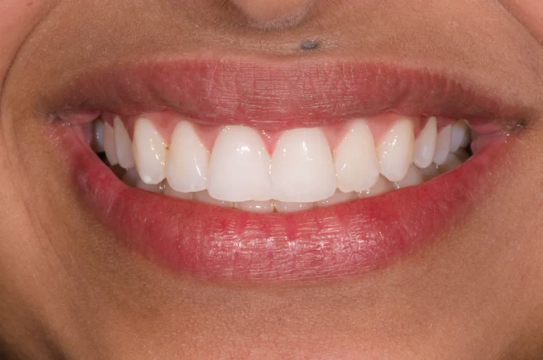 invisalign in harrogate