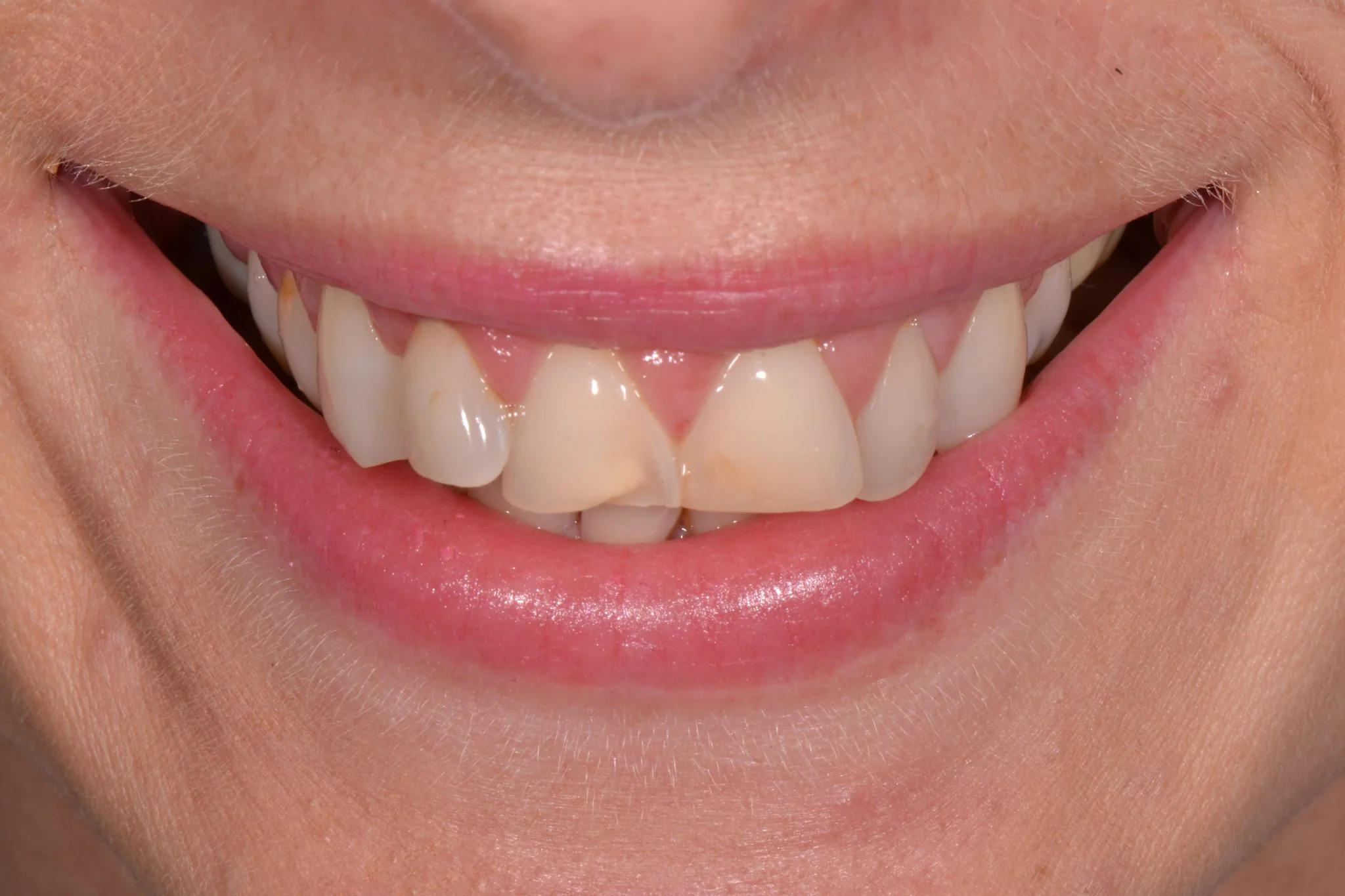 invisalign near harrogate