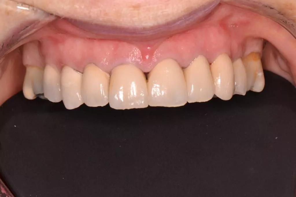 smile makeover after