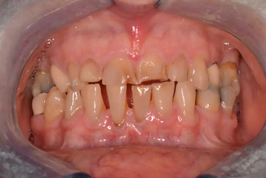 smile makeover before