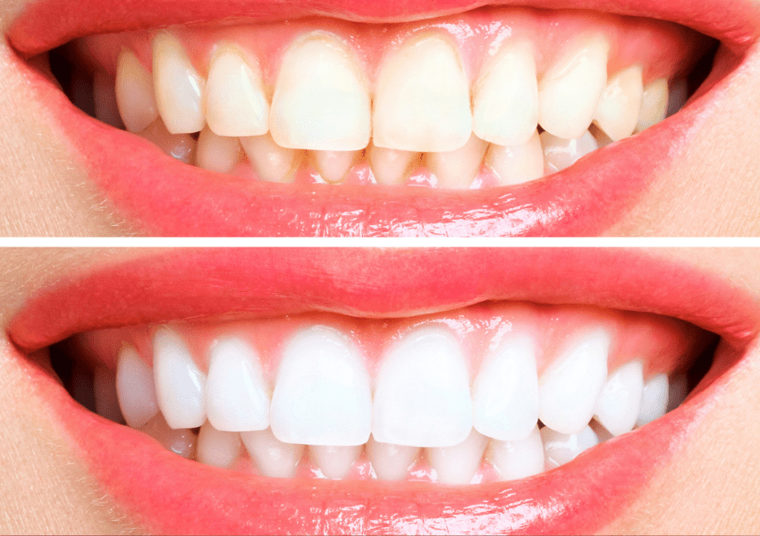 teeth whitening harrogate