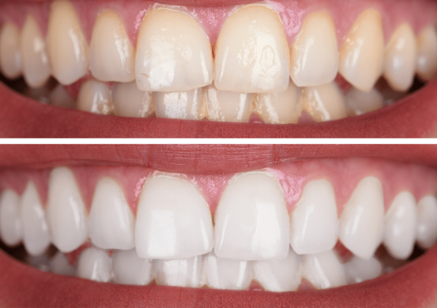 teeth whitening in harrogate