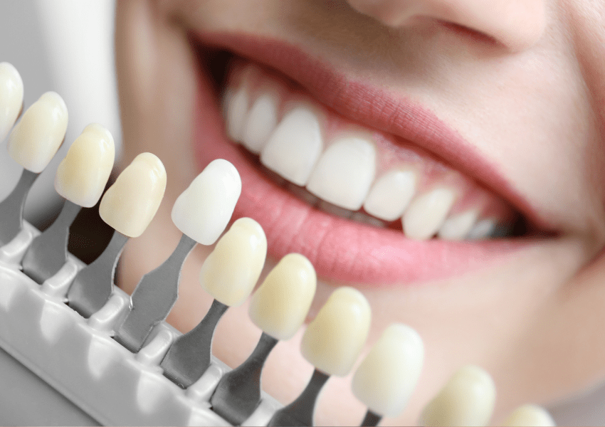 teeth whitening services in harrogate
