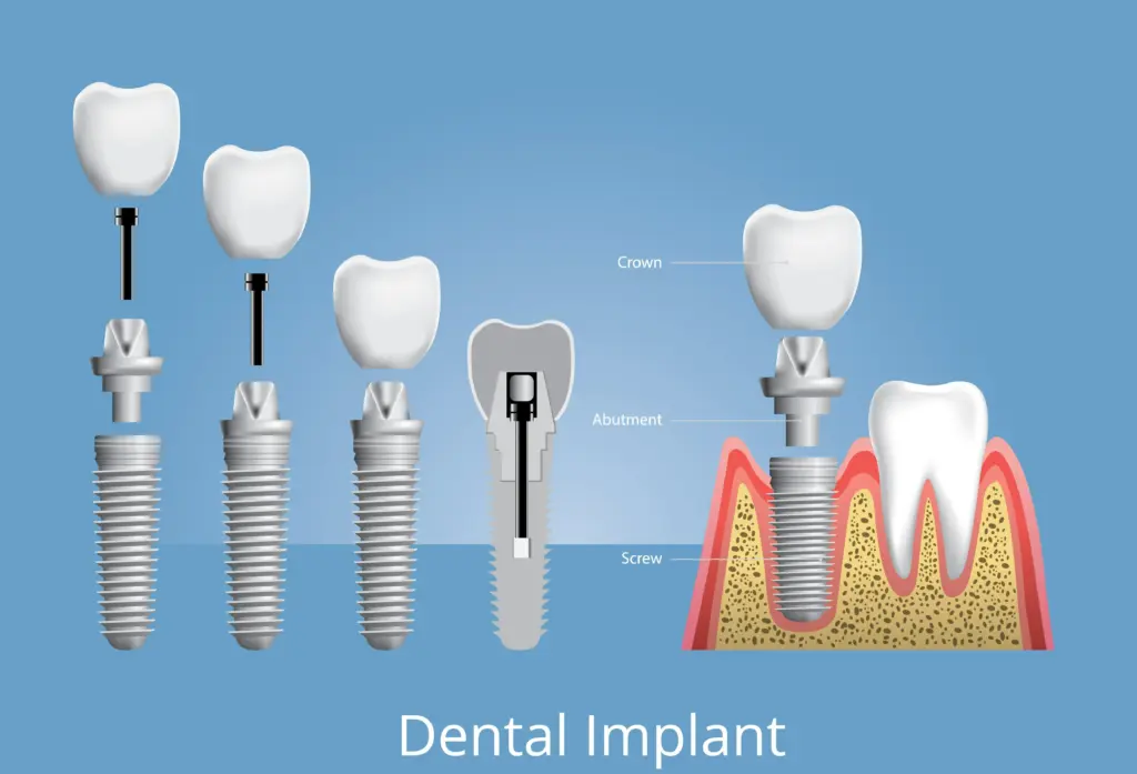 Labelled dental implant diagram showing crown, abutment and screw, illustrating factors affecting implant cost in the UK.