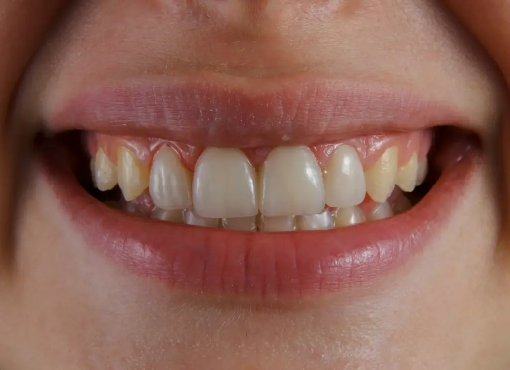 Smiling mouth showing healed gums after implant treatment, reassuring note on likely implant costs and recovery.